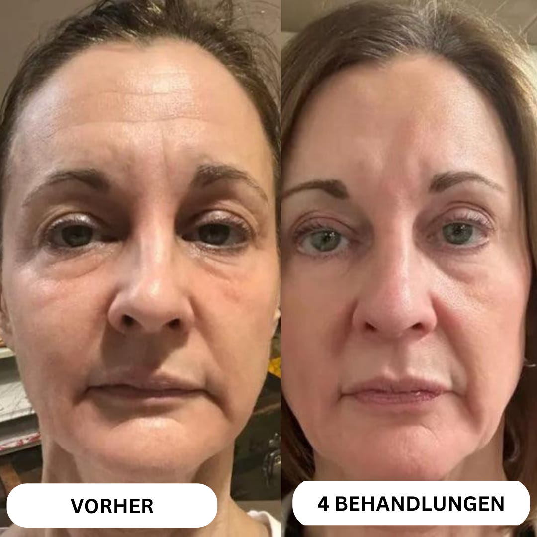 Natural Botulin 8-Wochen-Microinfusion-System™