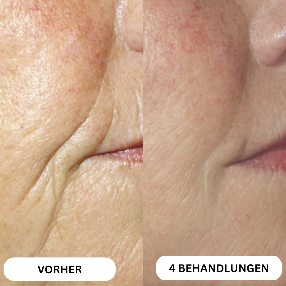 Natural Botulin 8-Wochen-Microinfusion-System™