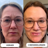 Natural Botulin 8-Wochen-Microinfusion-System™