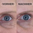Natural Botulin Microneedling Patches